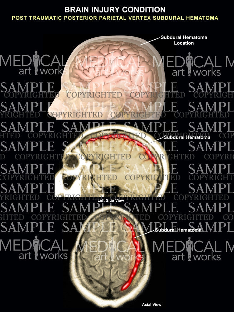 Brain subdural hematoma