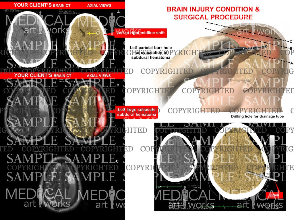 Brain subdural hematoma & evacuation