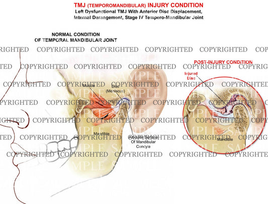 Temporomandibular joint disorder-left