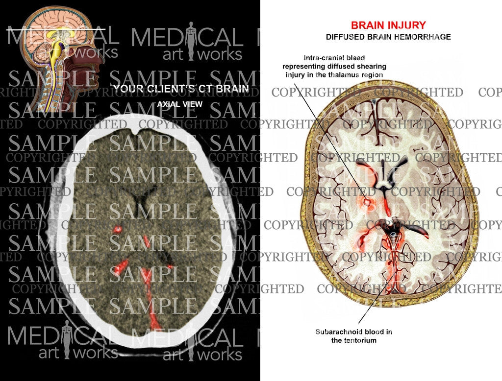Brain hemorrhage injury2