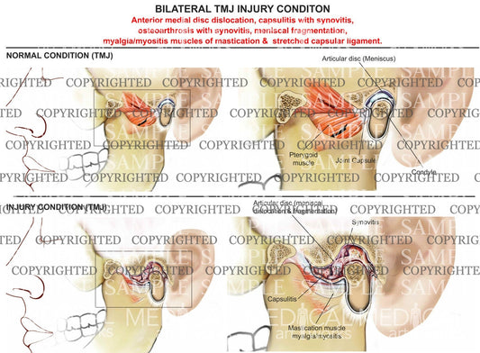 Bilateral TMJ injury