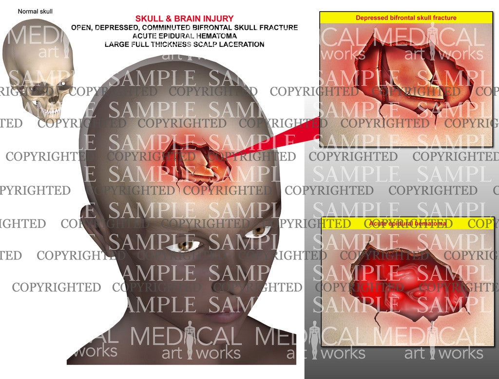 Skull fracture - epidural hematoma