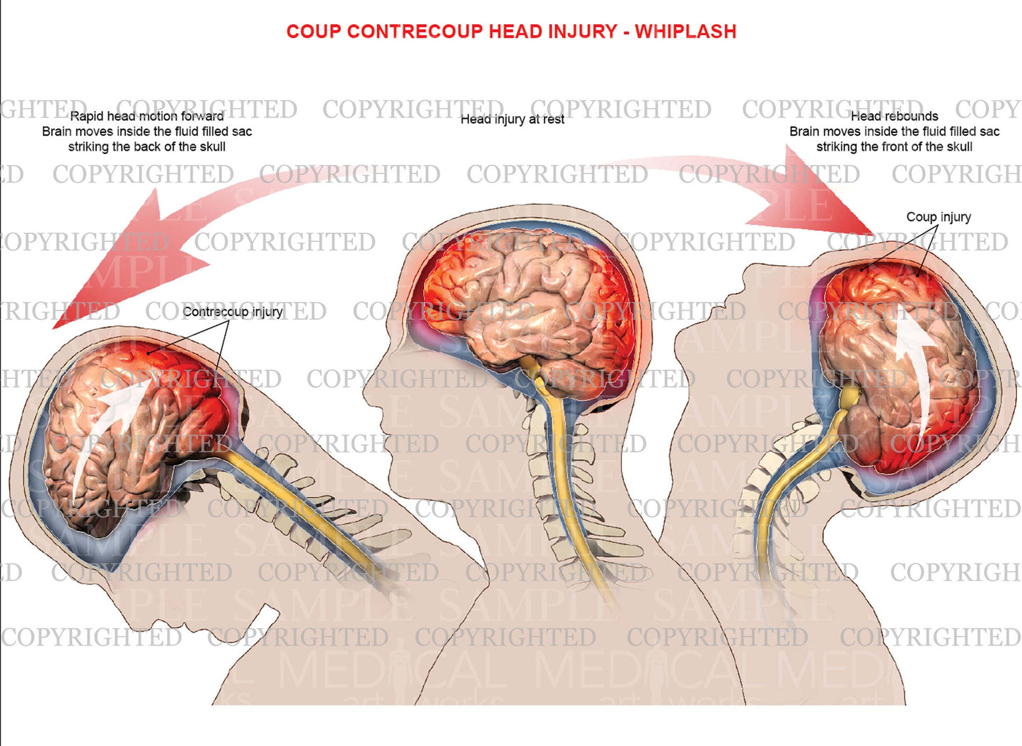 Mechanism of coup, contrecoup injury - Whiplash