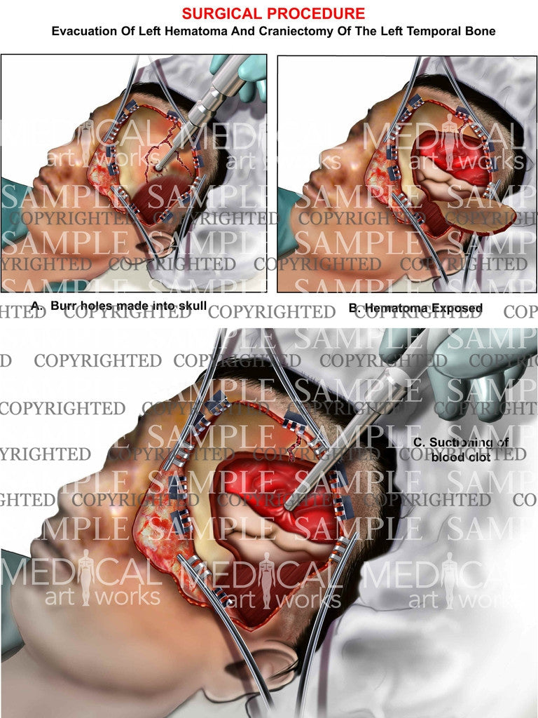 Traumatic brain hematoma evacuation1