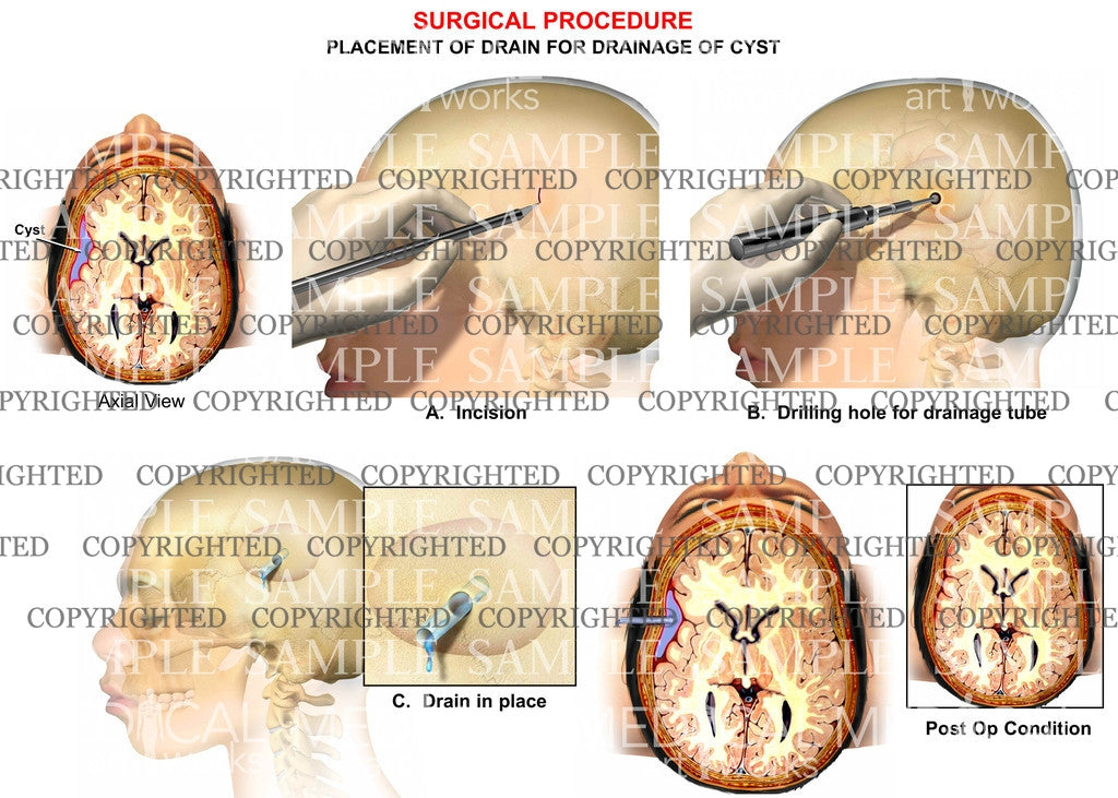 Brain cyst drainage procedure