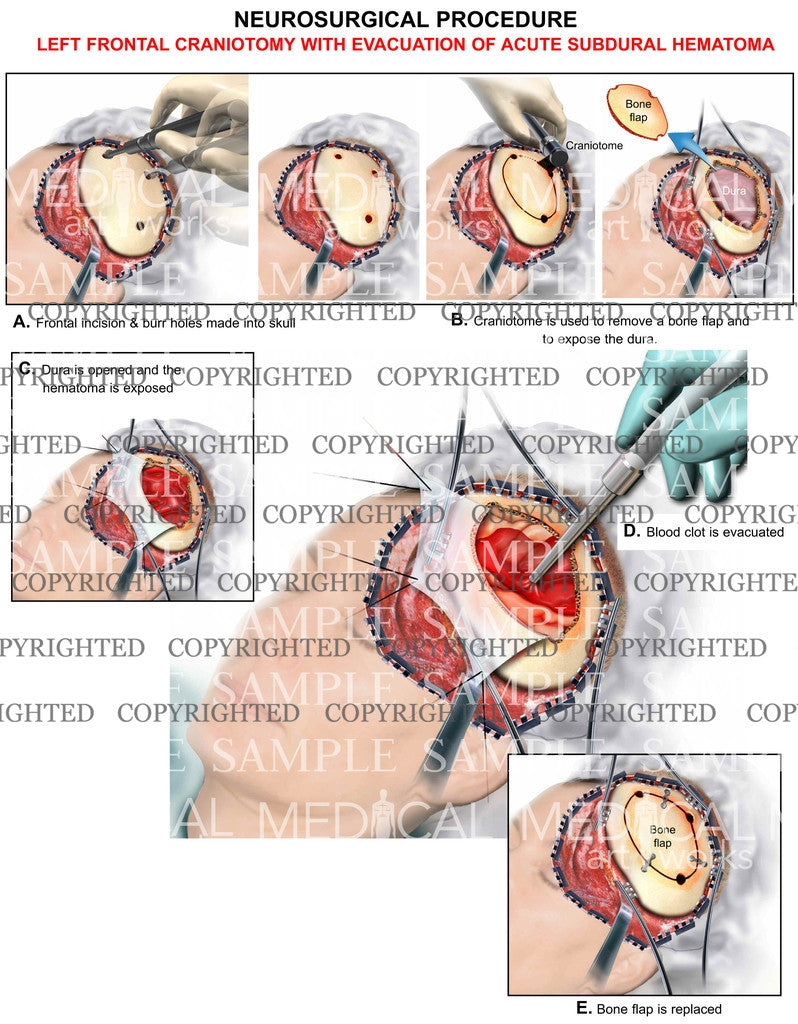 Frontal craniotomy+hematoma evacuation