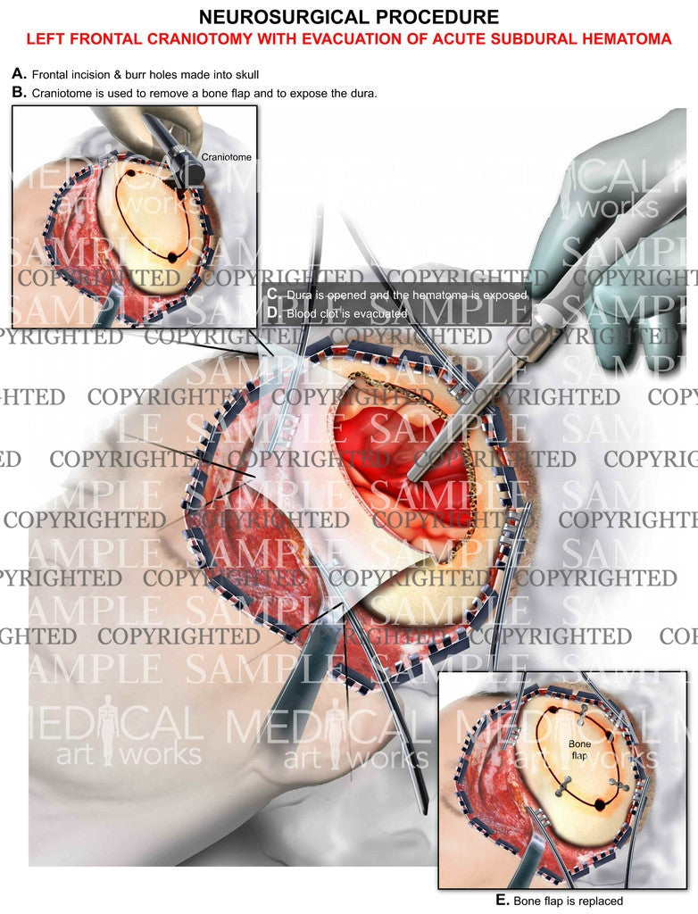Frontal craniotomy+hematoma evacuation2