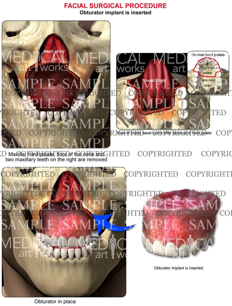 Maxilla deformity-obturator implant