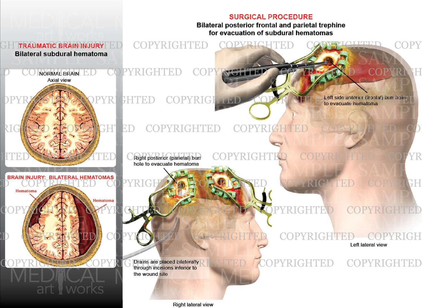 Brain surgery of bilateral subdural hematoma traumatic brain - Evacuation of hematomas