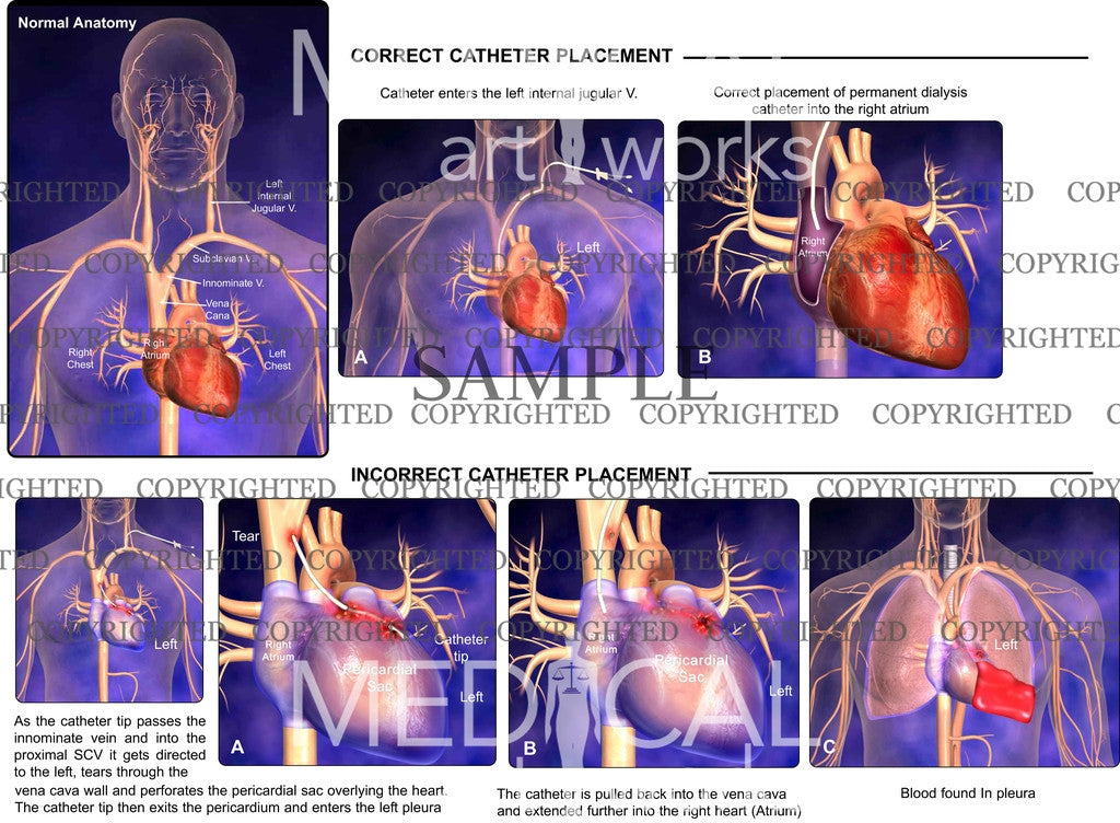 Correct Catheter Placement and Incorrect Catheter Placement