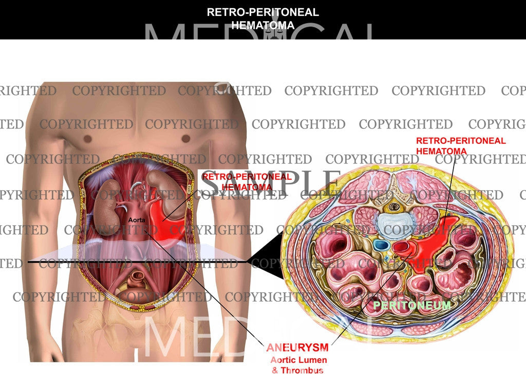 Retroperitoneal Hematoma 1