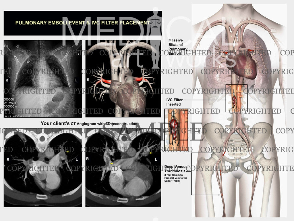 Pulmonary emboli event & IVC filter placement