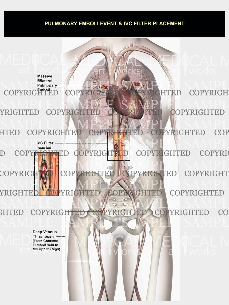 Pulmonary emboli event and IVC filter placement