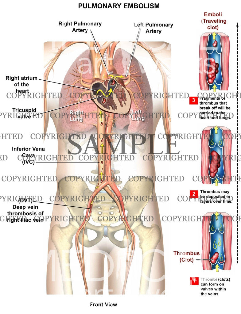 pulmonary embolism