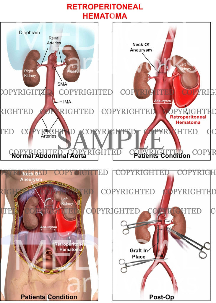 Retroperitoneal Hematoma