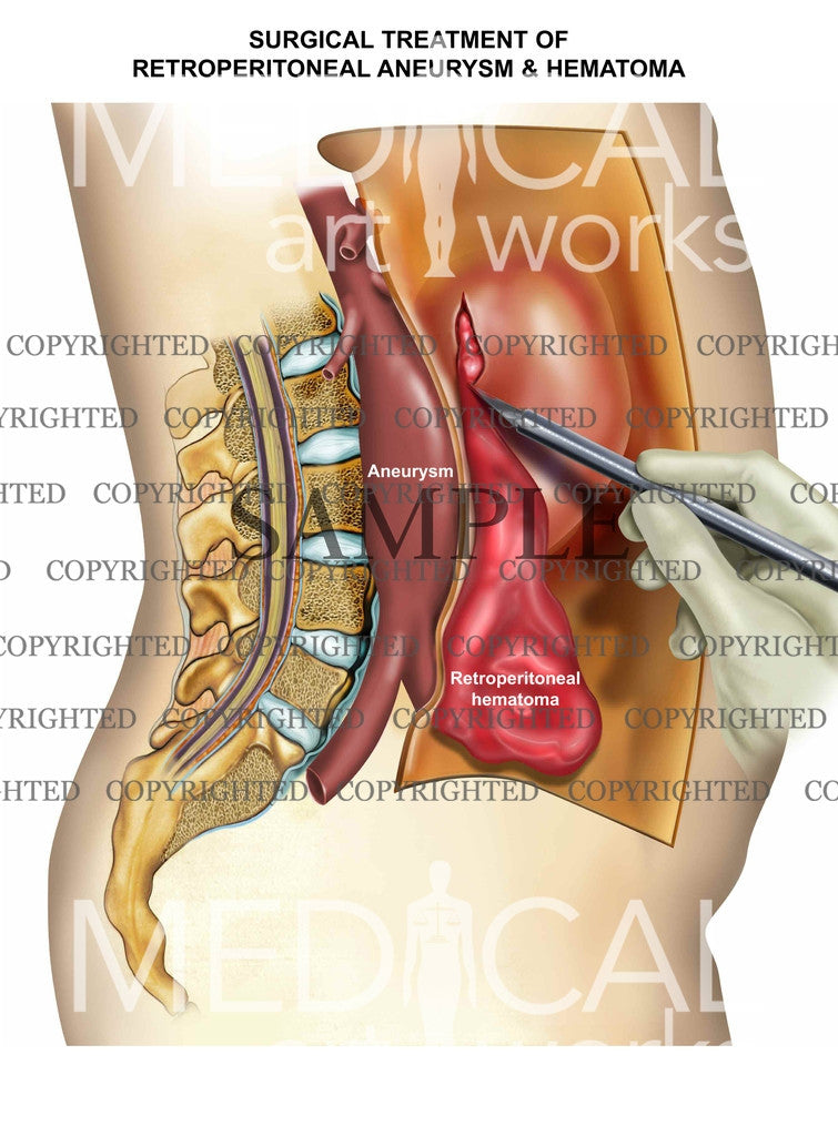 Retroperitoneal Hematoma surgery