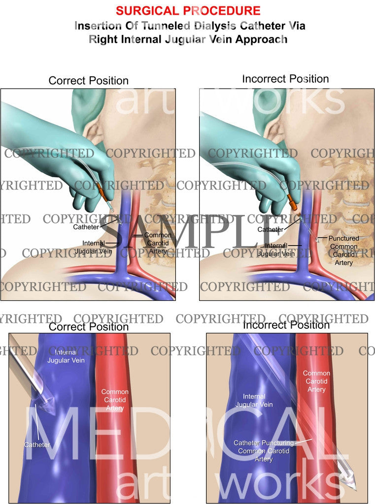 Jugular vein surgical procedure