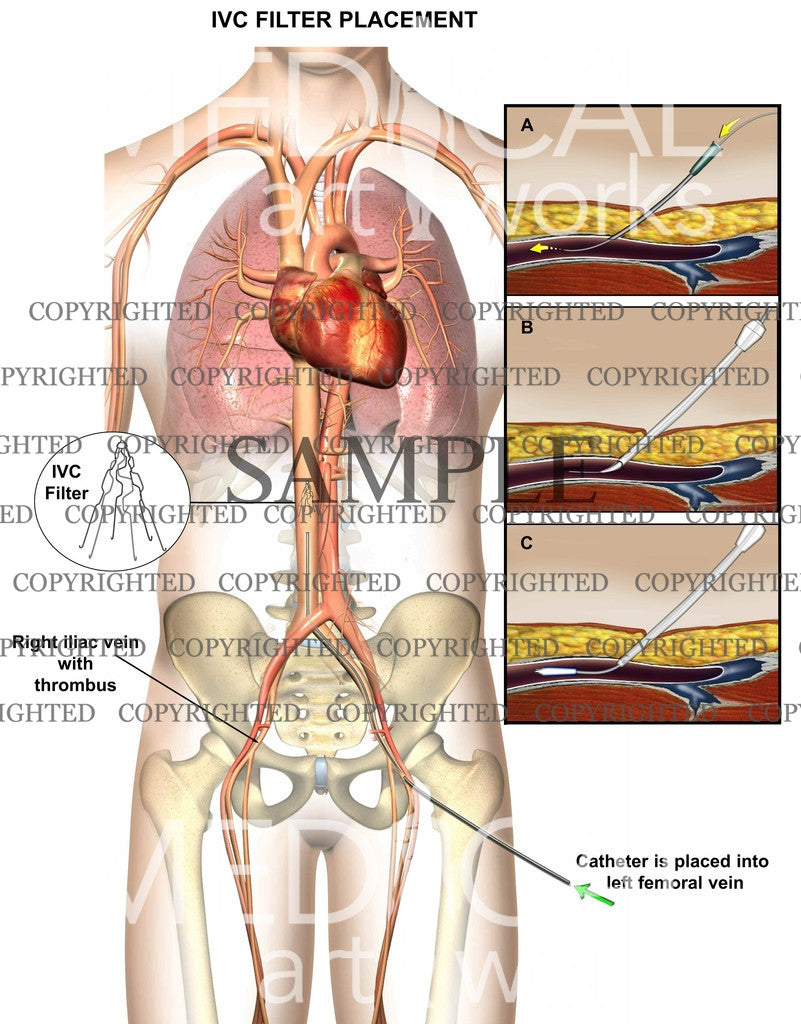 Pulmonary emboli event & IVC filter