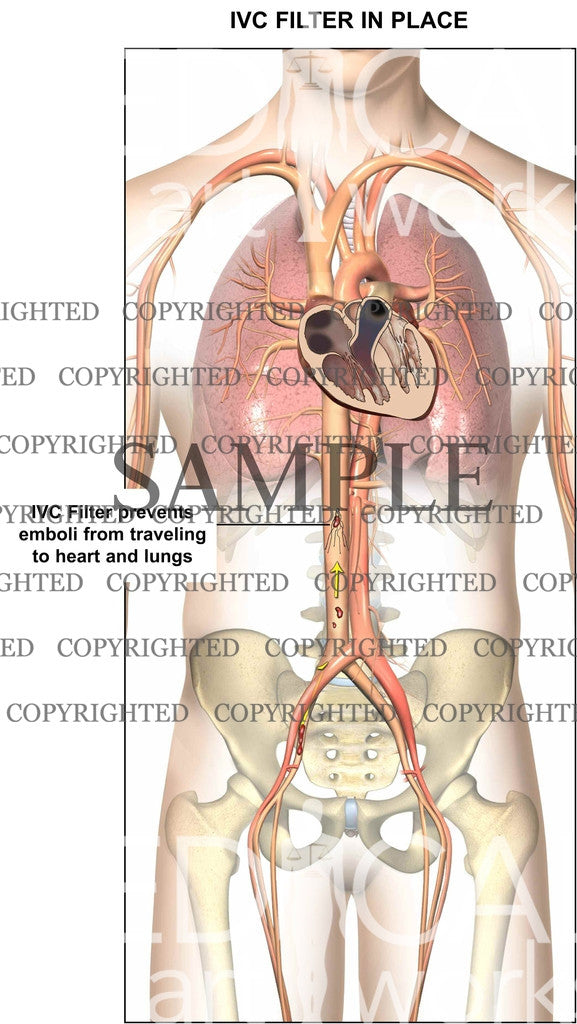 IVC Filter in place