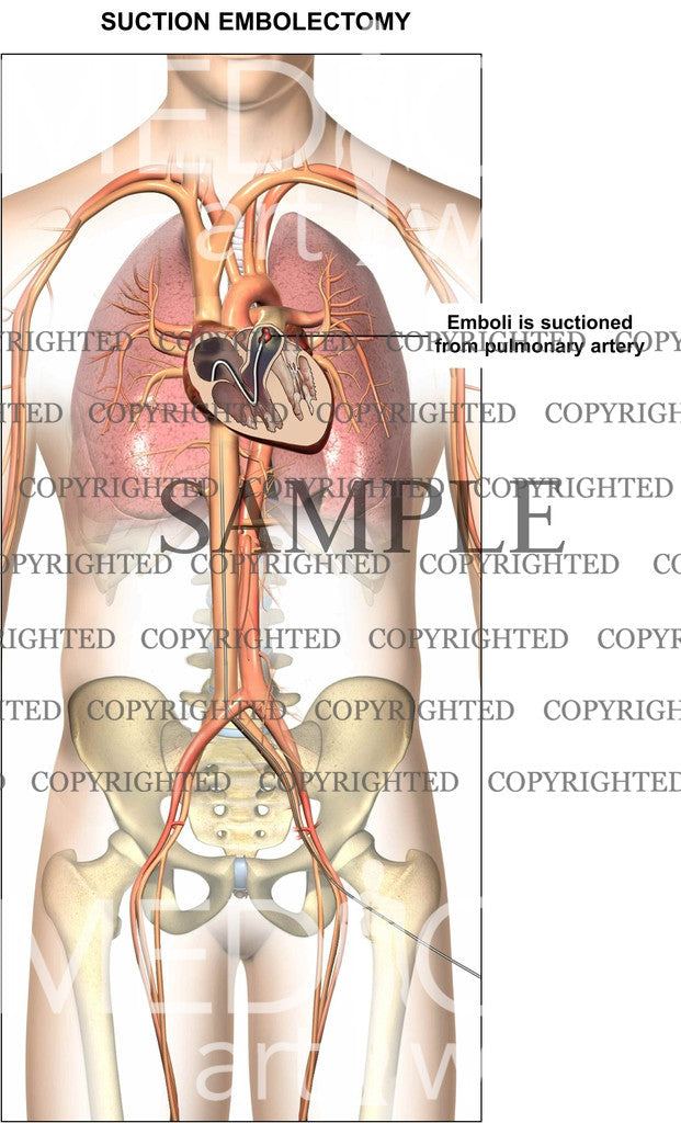 Suction Embolectomy