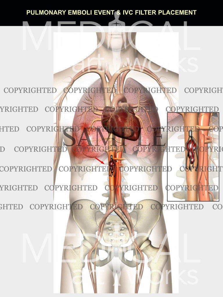 Pulmonary emboli event & IVC filter 3