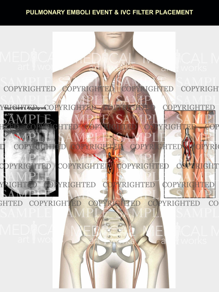 Pulmonary emboli event & IVC filter with your client's angiogram