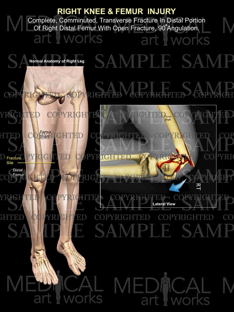 Right knee / femur fracture