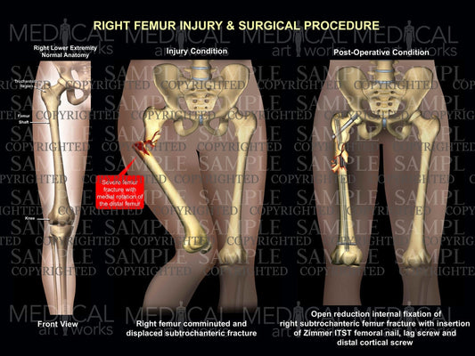 Right femur injury / surgery