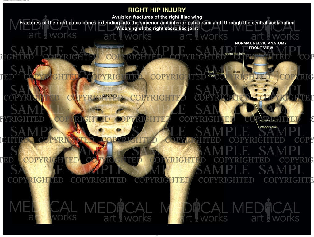 Right pelvis injury