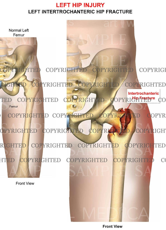 Left femur intertrochanteric fracture