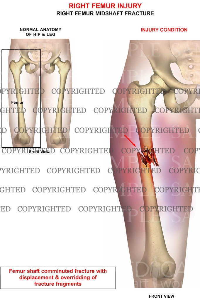 Right femur injury