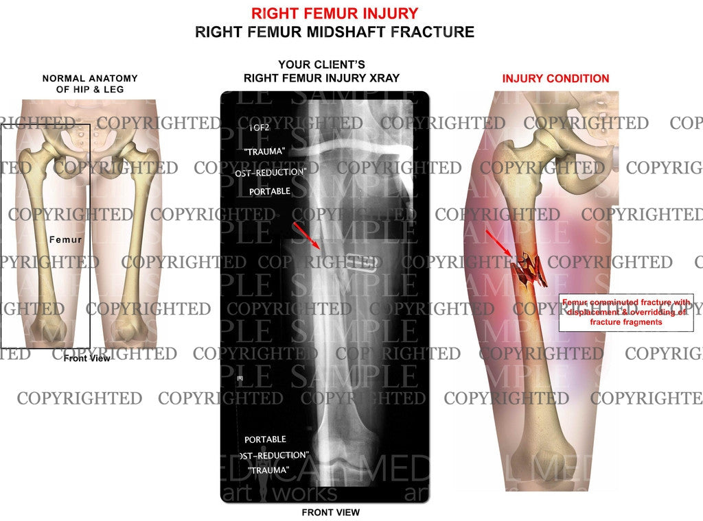 Right femur injury with x-ray