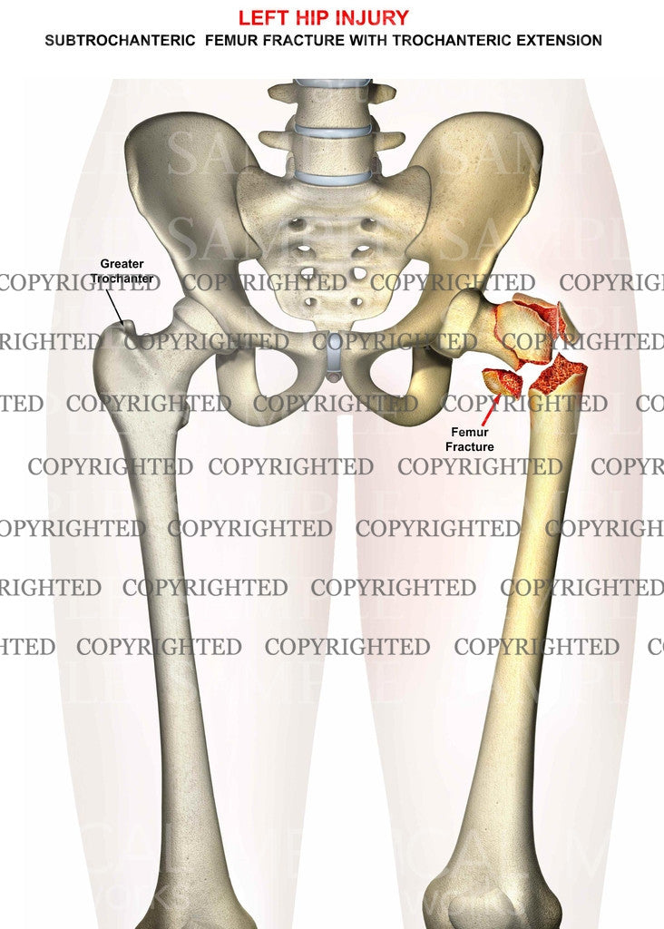 Left subtrochanteric femur fracture