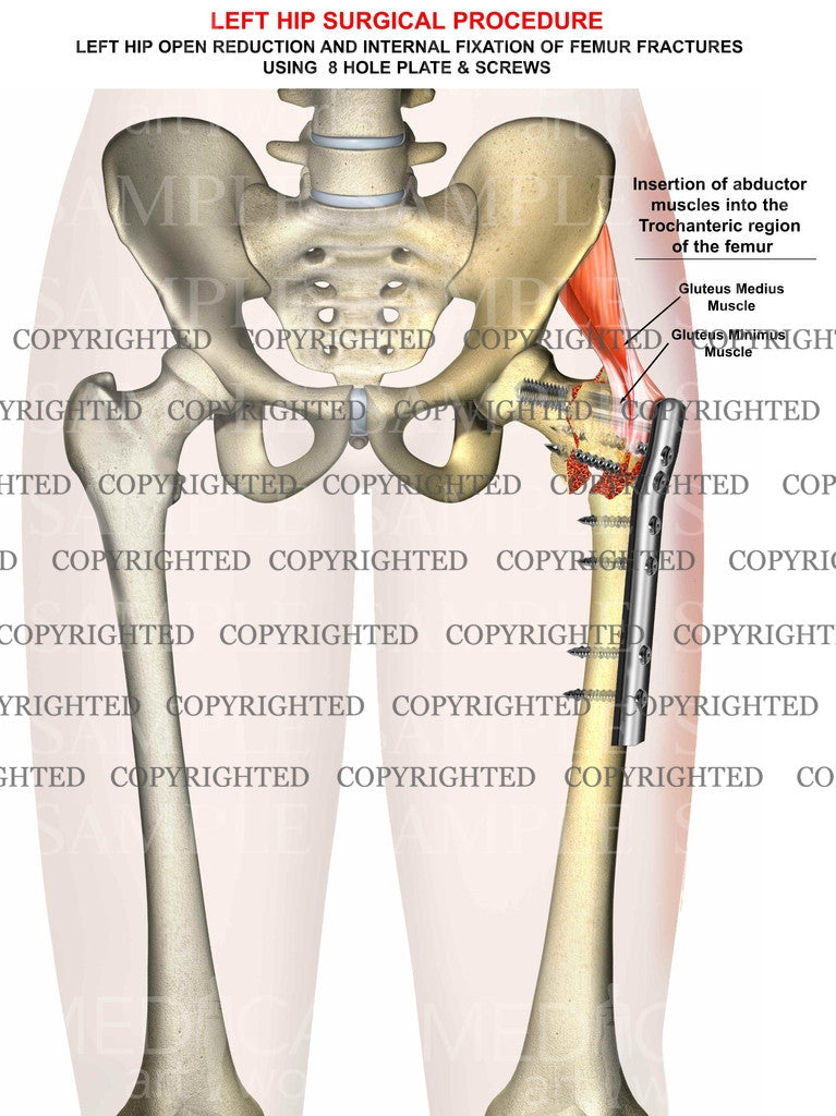 Left femur intertrochanteric fracture - ORIF