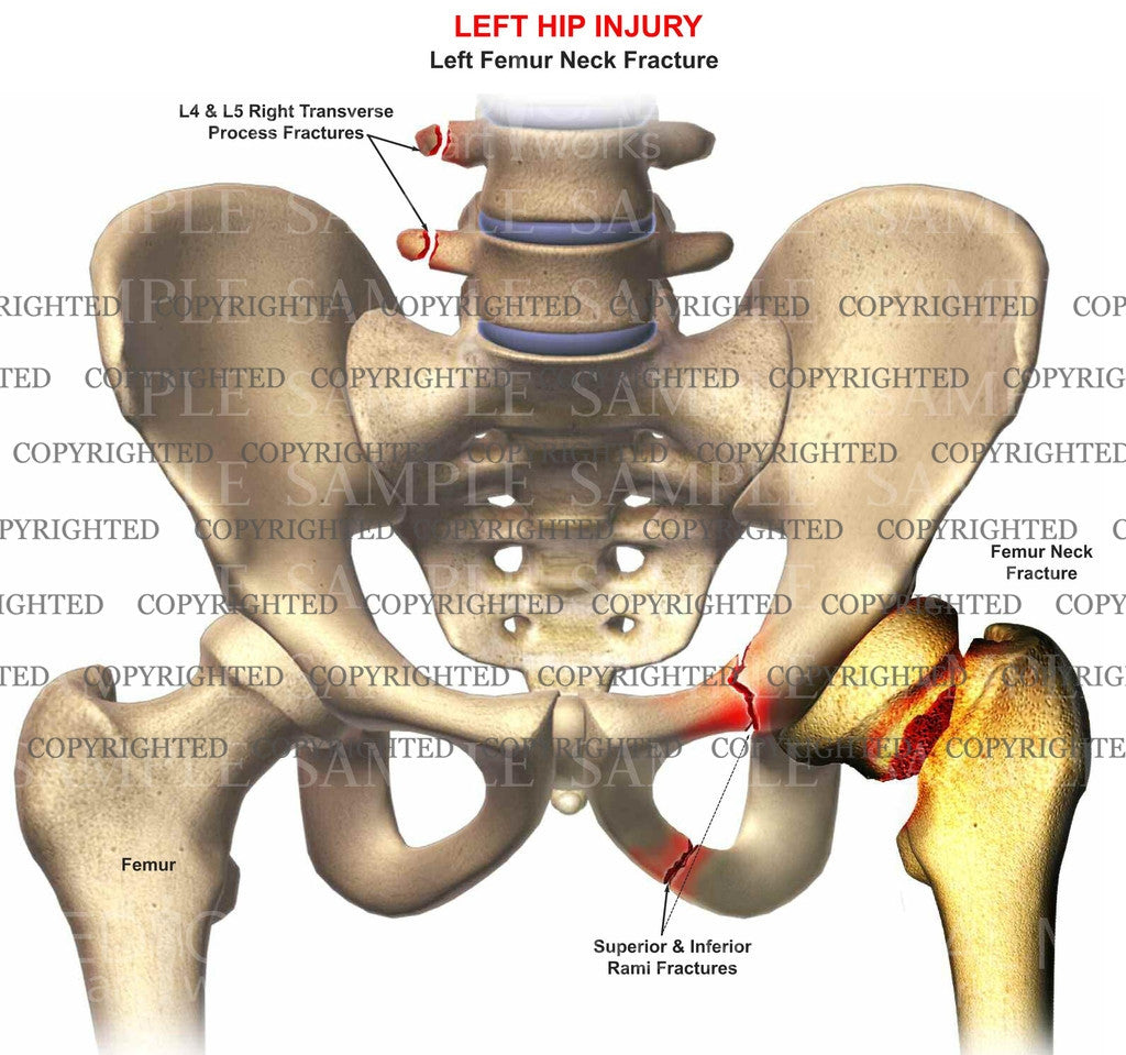 Left femur neck, rami fractures