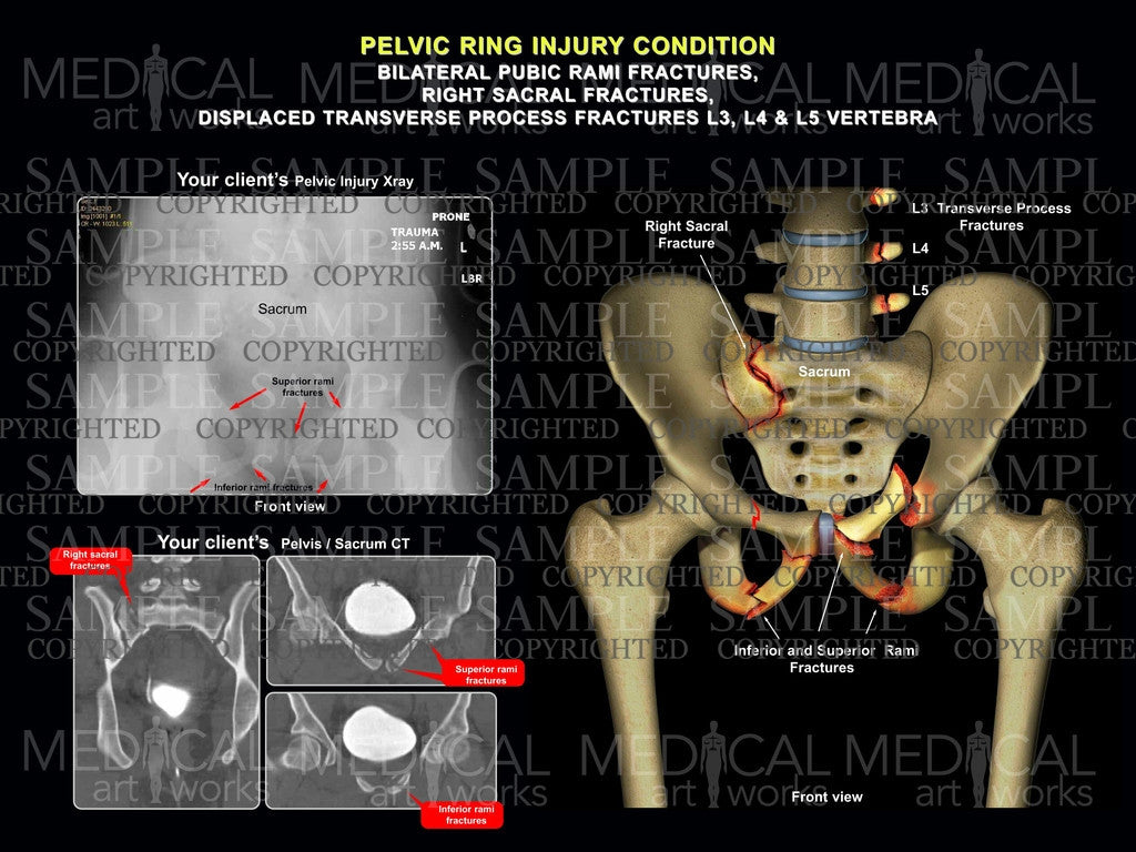 Bilateral hip fractures injury and xrays