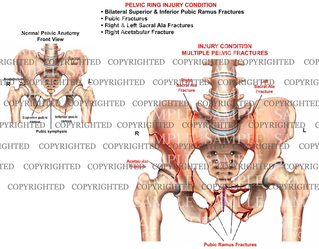 PELVIC RING Injury condition 2