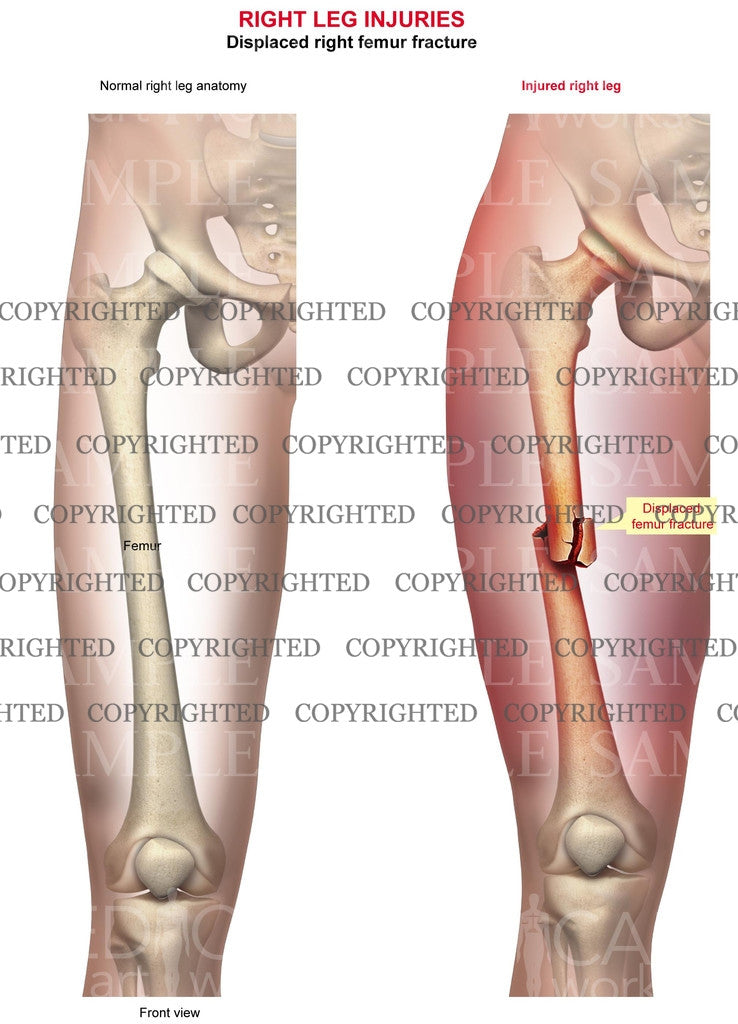 Right femur fracture