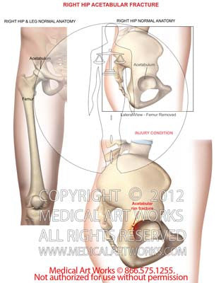 Right hip acetabular fracture