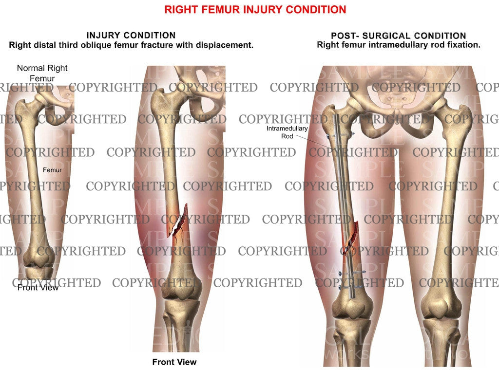 Mid-shaft femur fracture