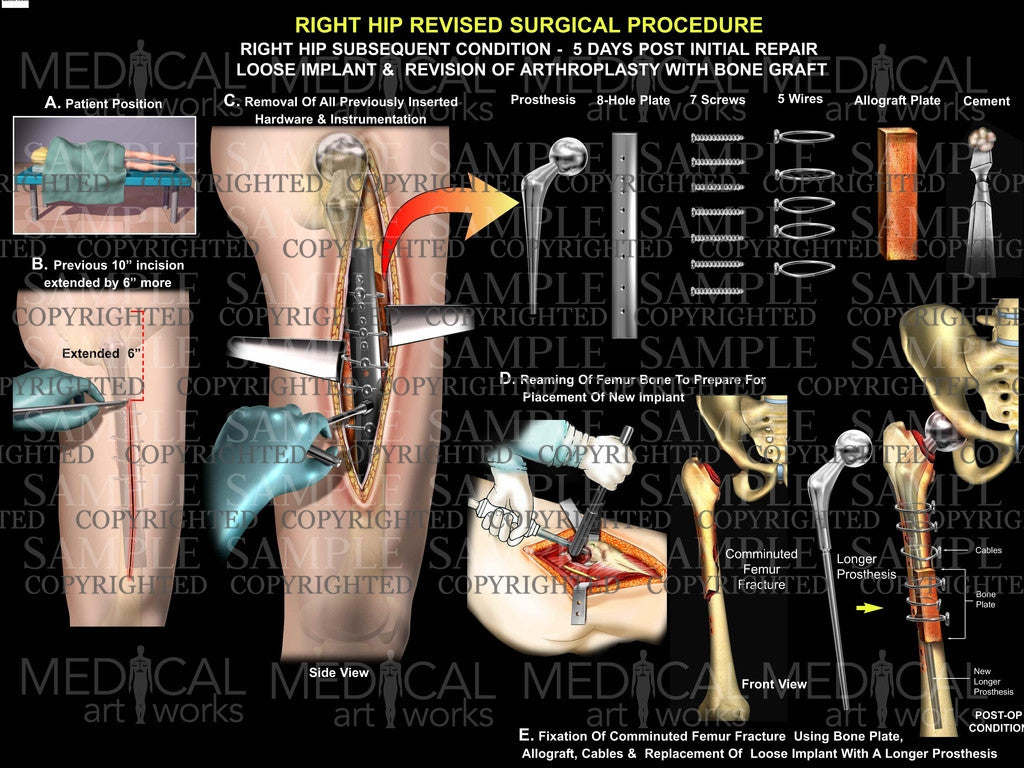 right hip loose implant revision surgery