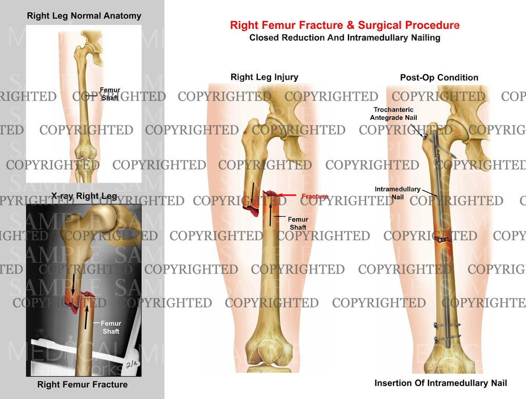 Right femur mid shaft fracture & Intramedullary nailing