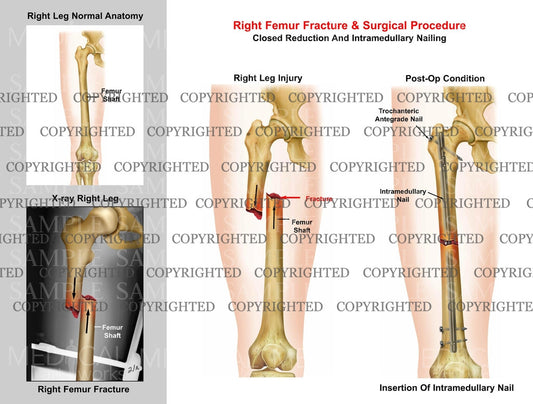 Right femur mid shaft fracture & Intramedullary nailing