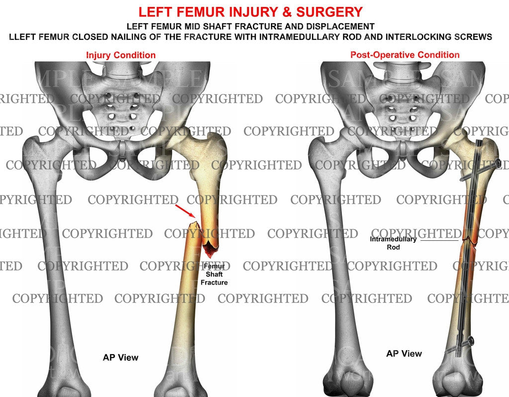 Closed Femur Fracture closed-femur-fracture