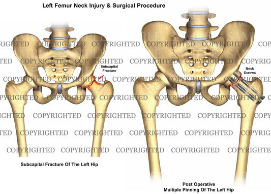 Left femur subcapital fracture & hip pinning procedure