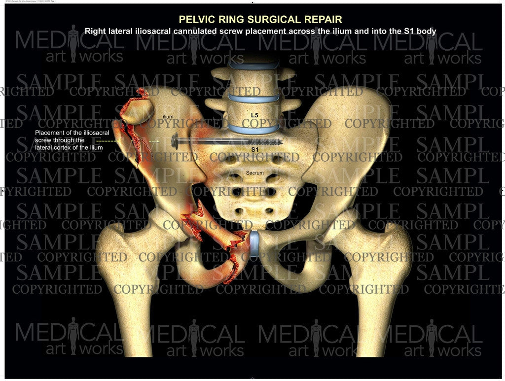 Pelvic ring iliosacral repair