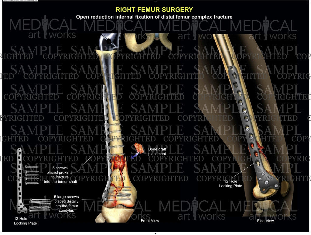 Right leg surgical procedure