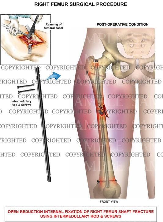 Right leg surgical procedure
