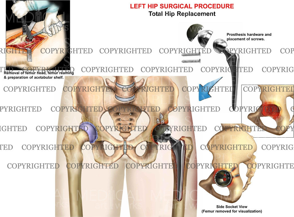 Total hip replacement, left