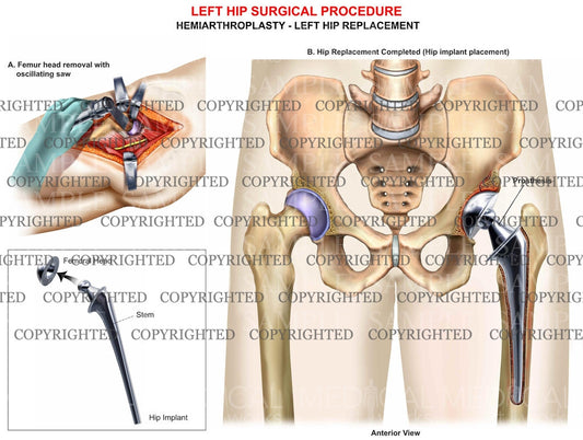 Left hip hemiarthroplasty surgical procedure